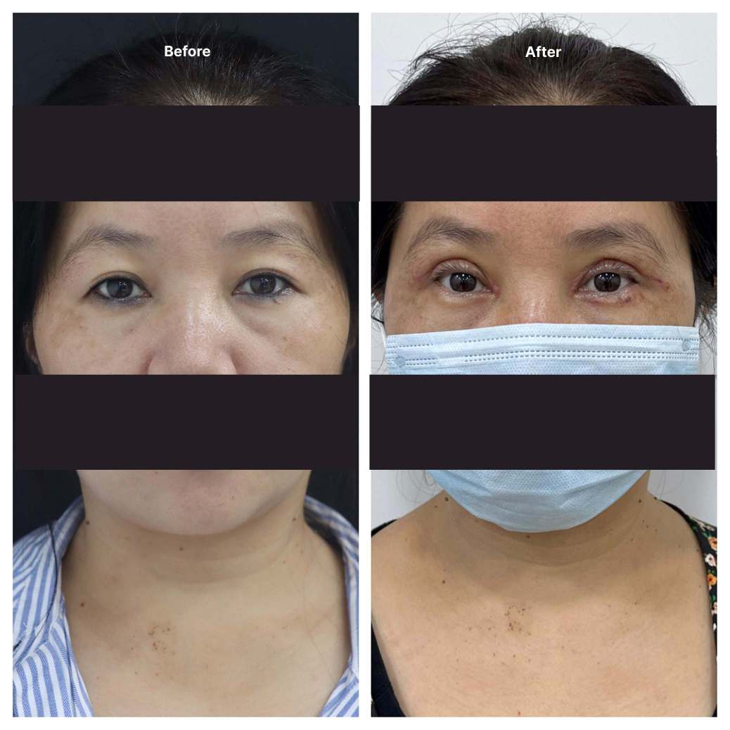Eyelid Surgery KOQ10